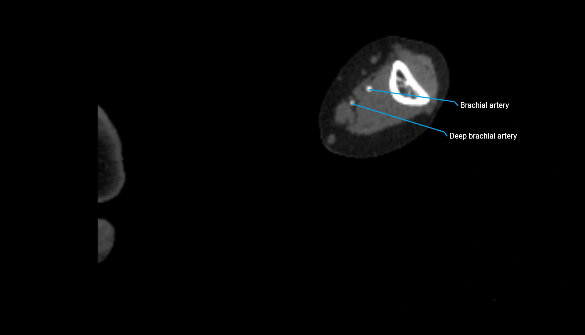 CTA upper limb axial cross sectional anatomy labelled image 205 (2).webp